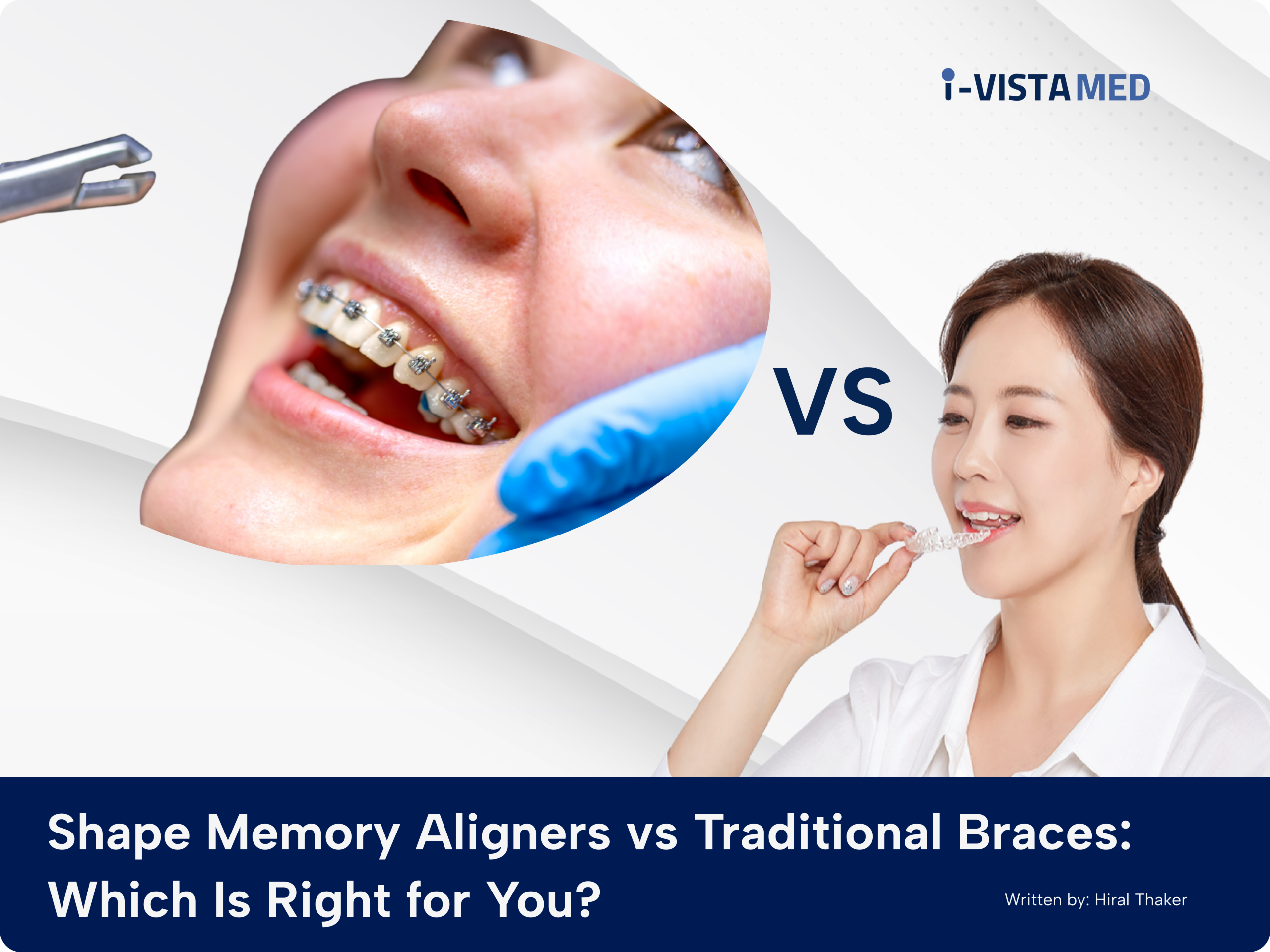 Shape Memory Aligners vs Traditional Braces_ Which Is Right for You